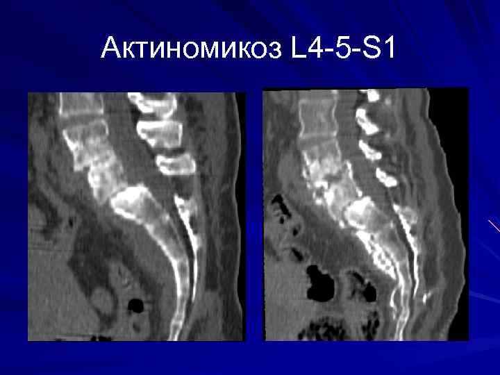 Актиномикоз L 4 -5 -S 1 