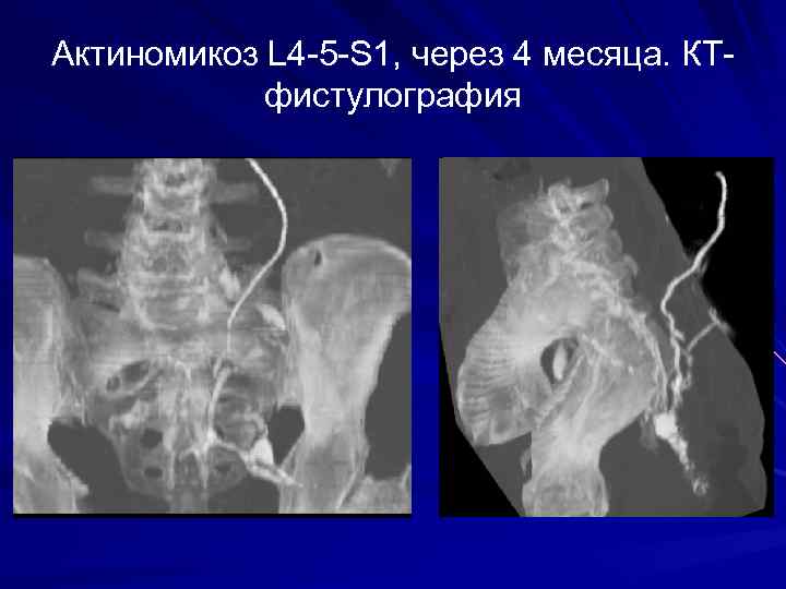 Актиномикоз L 4 -5 -S 1, через 4 месяца. КТ- фистулография 