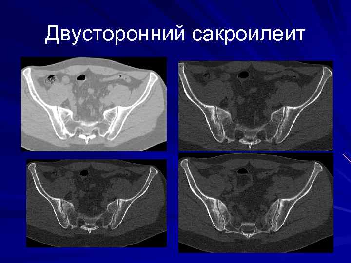 Двусторонний сакроилеит 