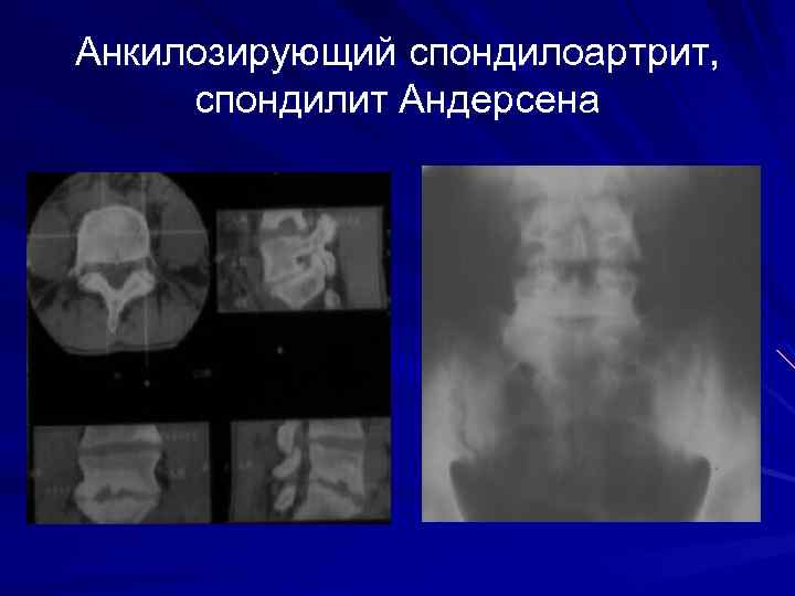 Анкилозирующий спондилоартрит, спондилит Андерсена 