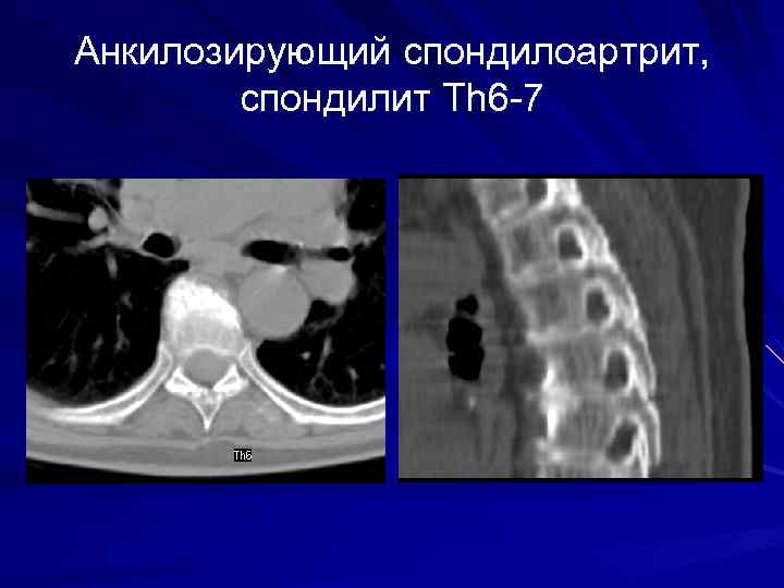 Анкилозирующий спондилоартрит, спондилит Th 6 -7 