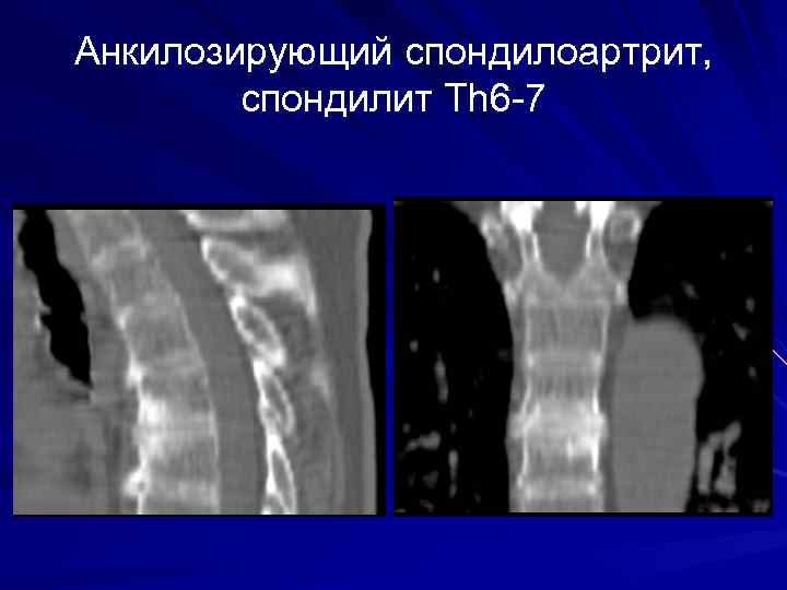 Анкилозирующий спондилоартрит, спондилит Th 6 -7 