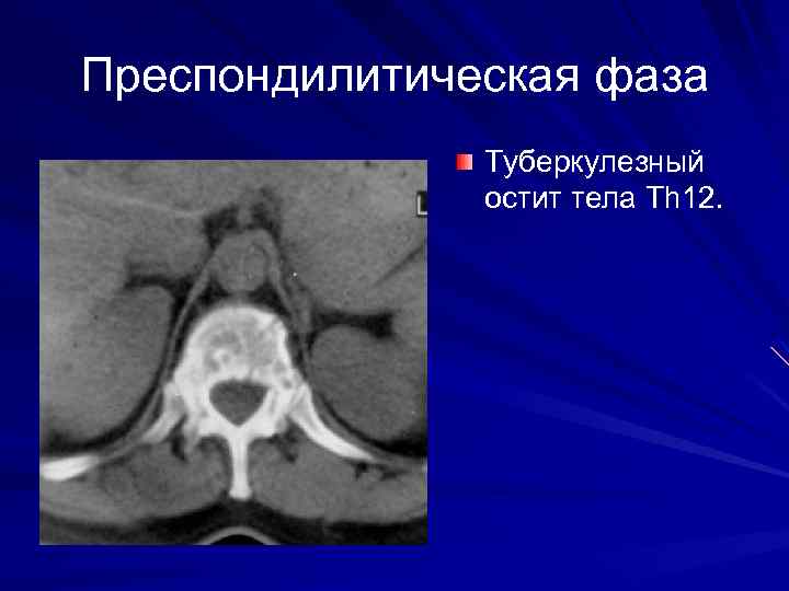 Преспондилитическая фаза Туберкулезный остит тела Th 12. 