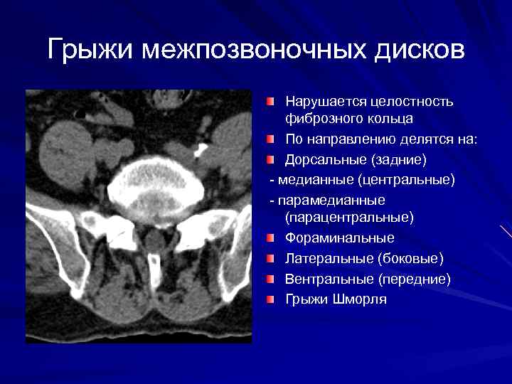 Грыжи межпозвоночных дисков Нарушается целостность фиброзного кольца По направлению делятся на: Дорсальные (задние) -