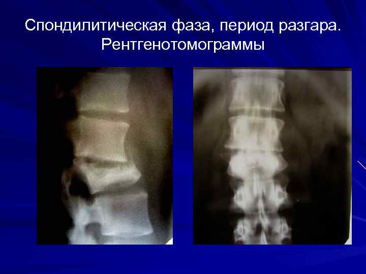 Спондилитическая фаза, период разгара. Рентгенотомограммы 