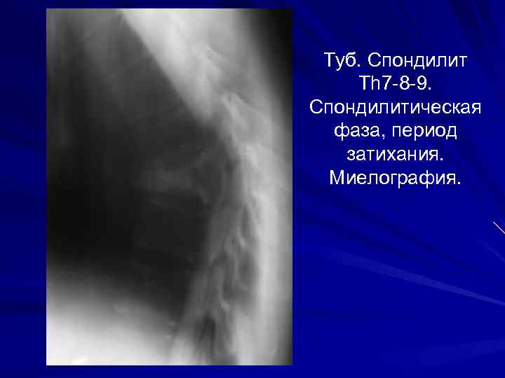 Туб. Спондилит Th 7 -8 -9. Спондилитическая фаза, период затихания. Миелография. 