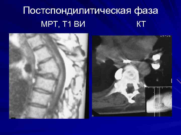Постспондилитическая фаза МРТ, Т 1 ВИ КТ 
