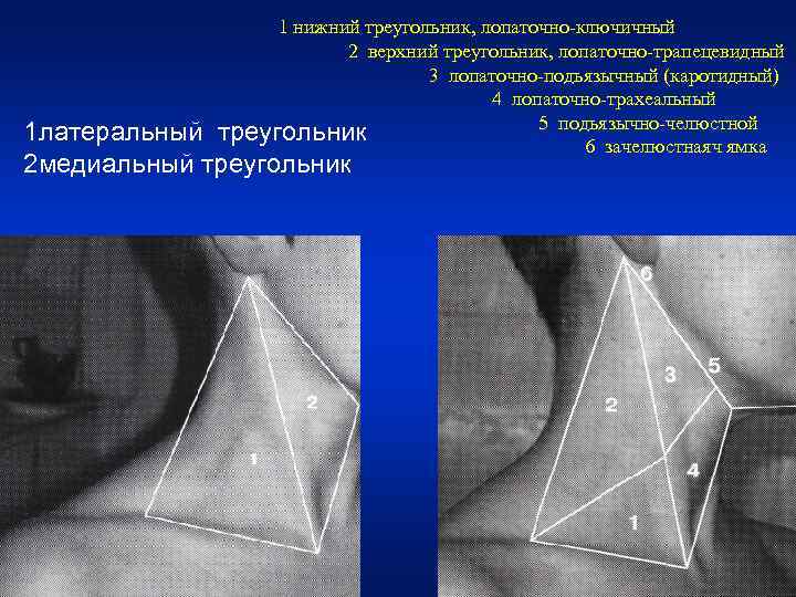 1 нижний треугольник, лопаточно-ключичный 2 верхний треугольник, лопаточно-трапецевидный 3 лопаточно-подьязычный (каротидный) 4 лопаточно-трахеальный 5