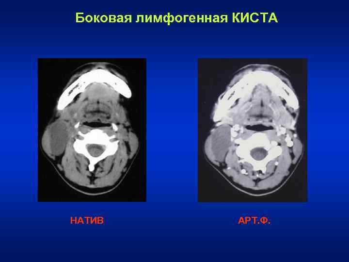 Боковая лимфогенная КИСТА НАТИВ АРТ. Ф. 