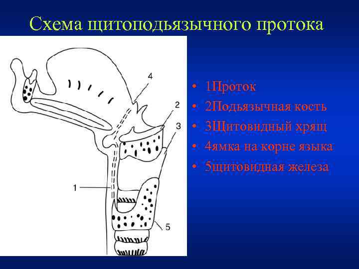 Схема щитоподьязычного протока • • • 1 Проток 2 Подьязычная кость 3 Щитовидный хрящ
