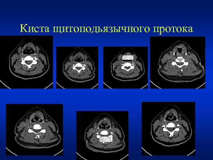 Киста щитоподьязычного протока • . 