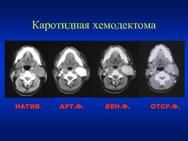 Каротидная хемодектома НАТИВ АРТ. Ф. ВЕН. Ф. ОТСР. Ф. 