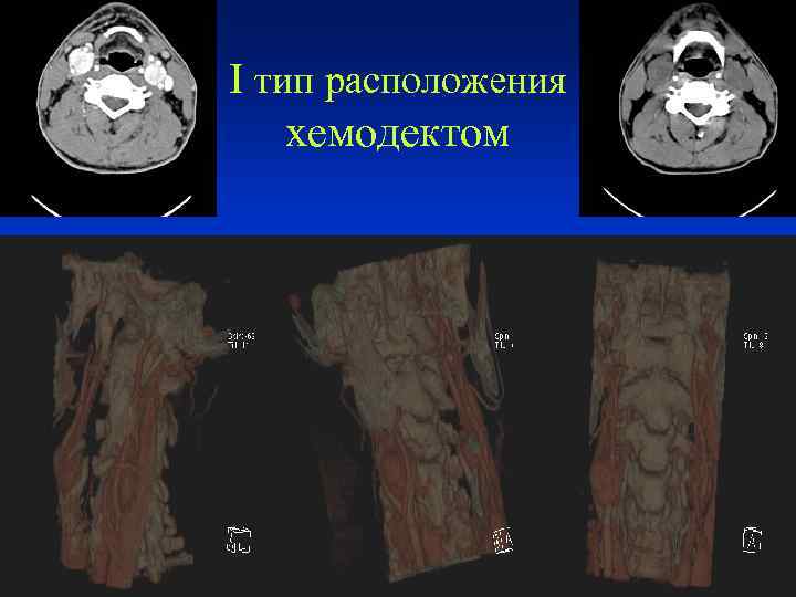 I тип расположения хемодектом 