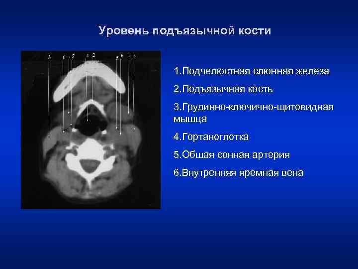 Уровень подъязычной кости 1. Подчелюстная слюнная железа 2. Подъязычная кость 3. Грудинно-ключично-щитовидная мышца 4.