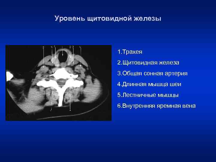 Уровень щитовидной железы 1. Трахея 2. Щитовидная железа 3. Общая сонная артерия 4. Длинная