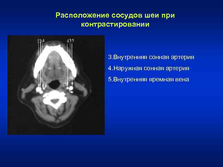 Расположение сосудов шеи при контрастировании 3. Внутренняя сонная артерия 4. Наружная сонная артерия 5.