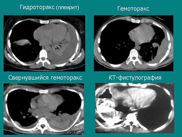 Гидроторакс (плеврит) Свернувшийся гемоторакс Гемоторакс КТ-фистулография 