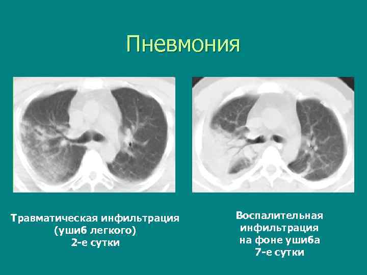 Пневмония Травматическая инфильтрация (ушиб легкого) 2 -е сутки Воспалительная инфильтрация на фоне ушиба 7