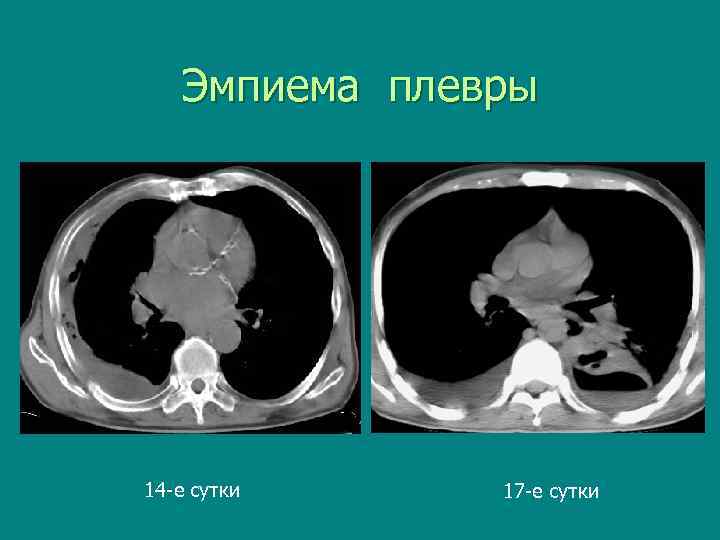 Эмпиема плевры 14 -е сутки 17 -е сутки 