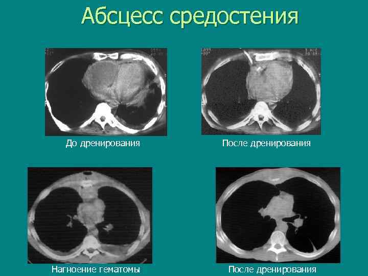 Абсцесс средостения До дренирования Нагноение гематомы После дренирования 
