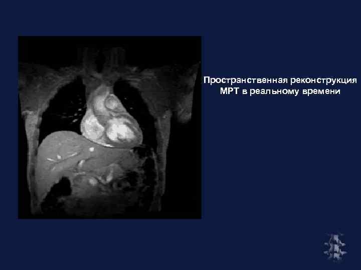 Пространственная реконструкция МРТ в реальному времени 