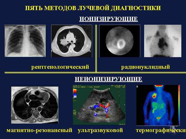 ПЯТЬ МЕТОДОВ ЛУЧЕВОЙ ДИАГНОСТИКИ ИОНИЗИРУЮЩИЕ рентгенологический радионуклидный НЕИОНИЗИРУЮЩИЕ магнитно-резонансный ультразвуковой термографический 