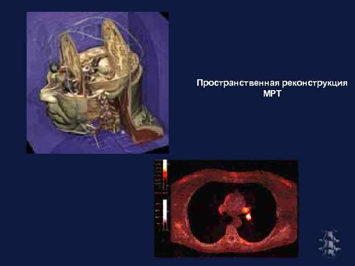 Пространственная реконструкция МРТ 