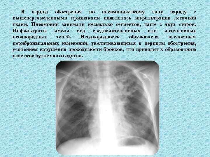 В период обострения по пневмоническому типу наряду с вышеперечисленными признаками появлялась инфильтрация легочной ткани.