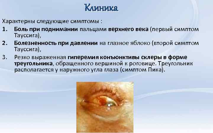 Клиника Характерны следующие симптомы : 1. Боль при поднимании пальцами верхнего века (первый симптом