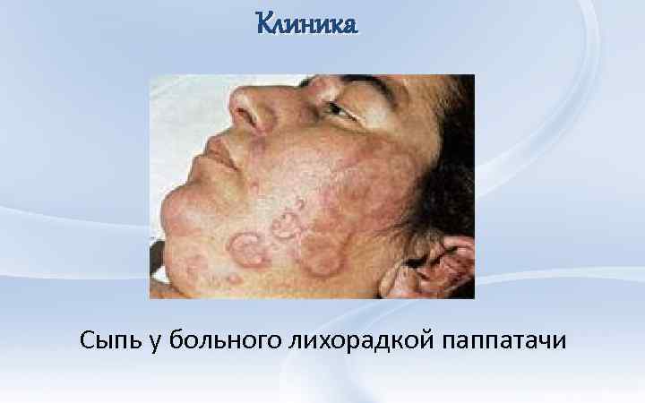Клиника Сыпь у больного лихорадкой паппатачи 