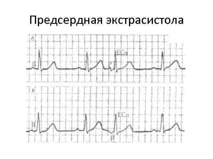 Предсердная экстрасистола 