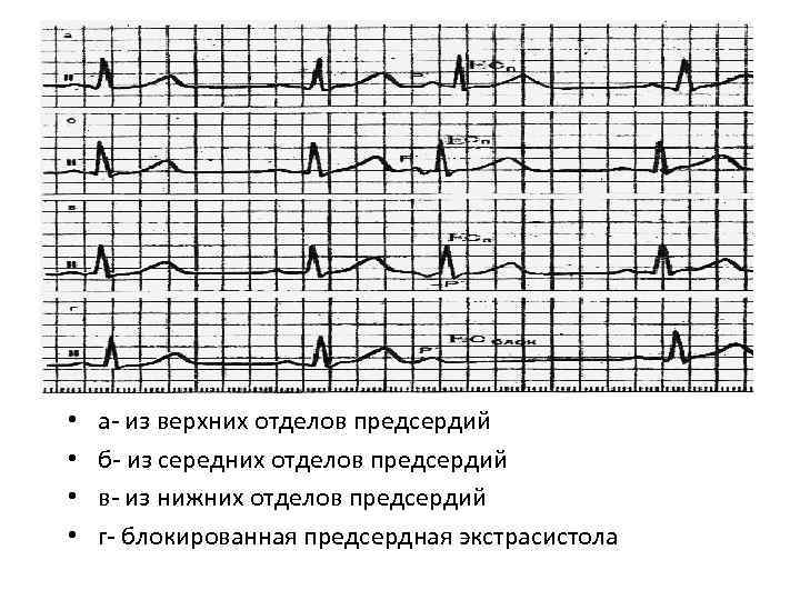  • • а из верхних отделов предсердий б из середних отделов предсердий в