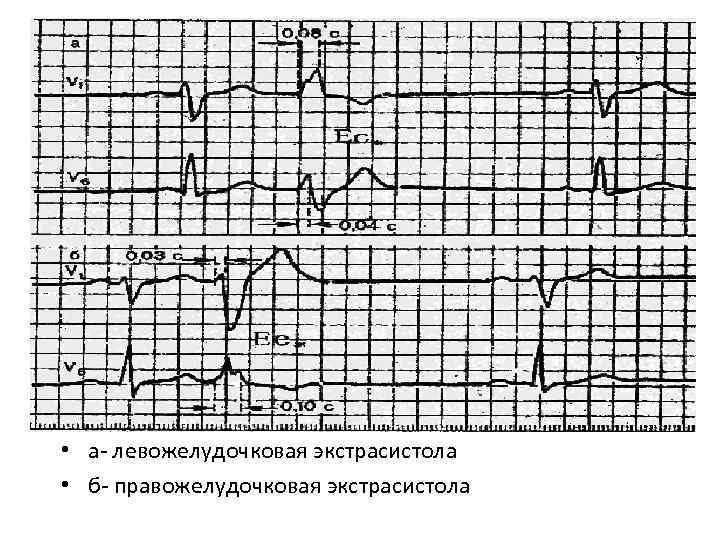  • а левожелудочковая экстрасистола • б правожелудочковая экстрасистола 