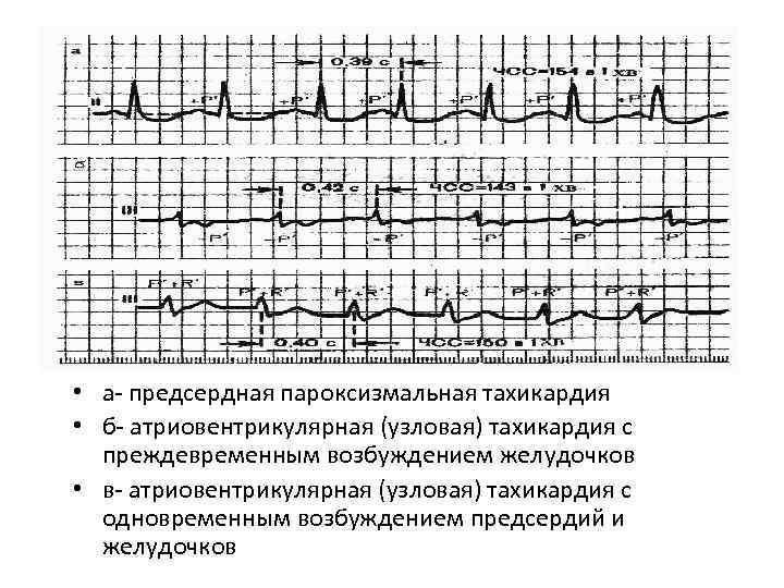  • а предсердная пароксизмальная тахикардия • б атриовентрикулярная (узловая) тахикардия с преждевременным возбуждением