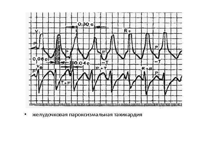  • желудочковая пароксизмальная тахикардия 