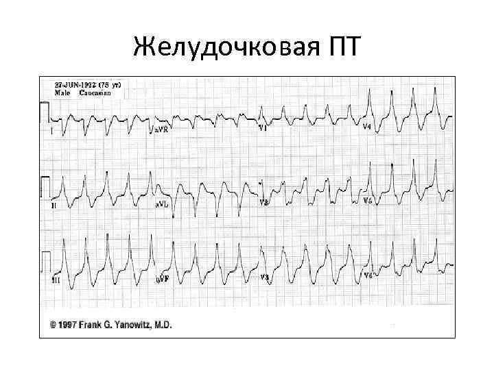 Желудочковая ПТ 