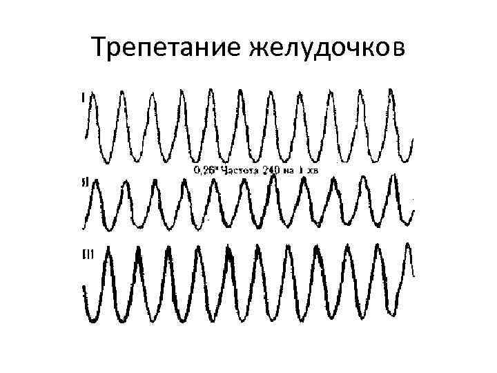 Трепетание желудочков 