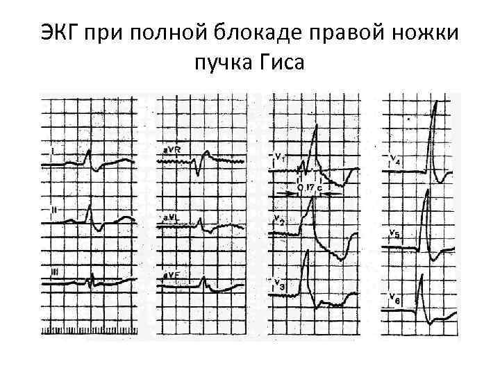 ЭКГ при полной блокаде правой ножки пучка Гиса 
