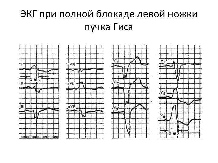 ЭКГ при полной блокаде левой ножки пучка Гиса 