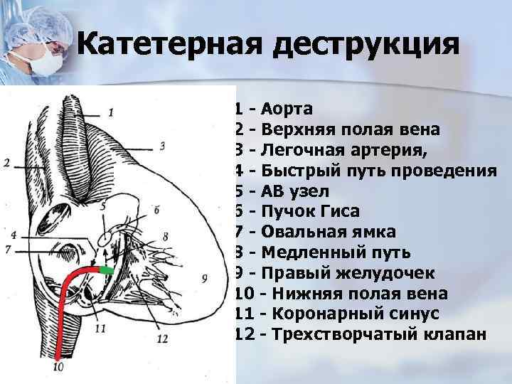 Катетерная деструкция 1 - Аорта 2 - Верхняя полая вена 3 - Легочная артерия,