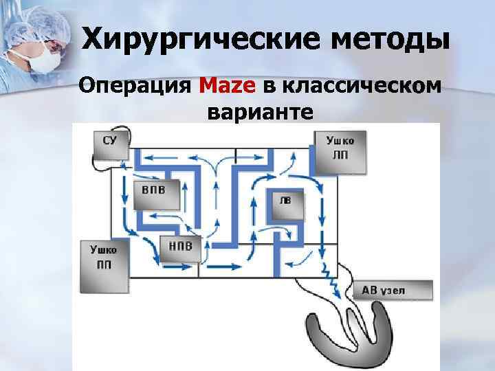 Хирургические методы Операция Maze в классическом варианте 