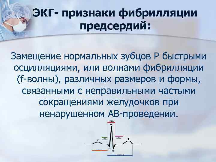ЭКГ- признаки фибрилляции предсердий: Замещение нормальных зубцов Р быстрыми осцилляциями, или волнами фибрилляции (f-волны),