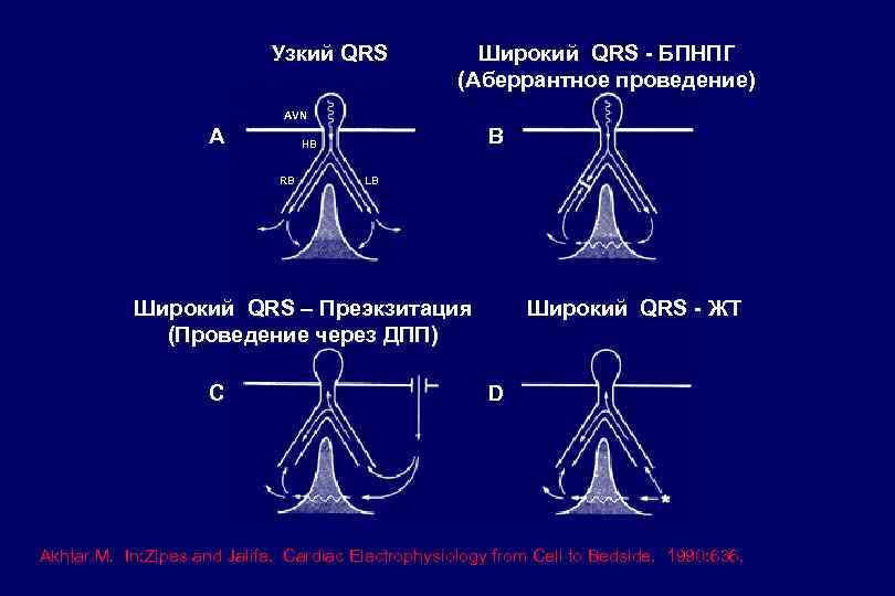 Узкий QRS Широкий QRS - БПНПГ (Аберрантное проведение) AVN A B HB RB LB