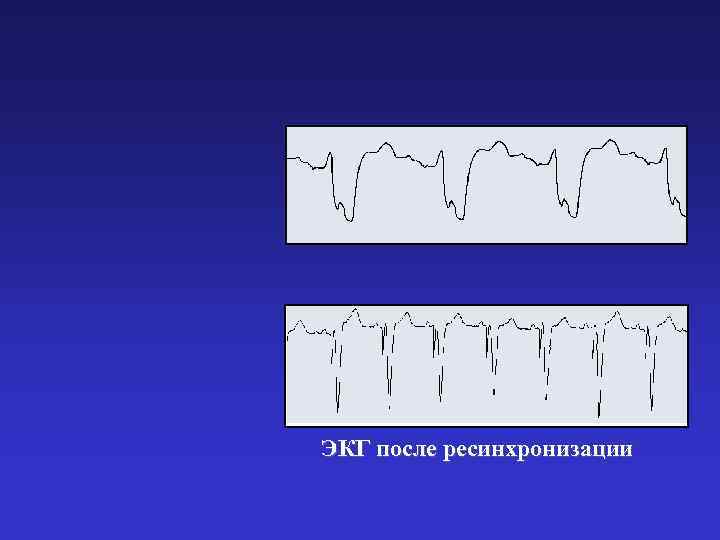 ЭКГ после ресинхронизации 