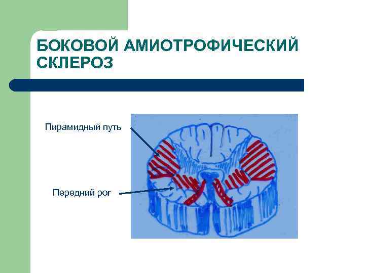 БОКОВОЙ АМИОТРОФИЧЕСКИЙ СКЛЕРОЗ Пирамидный путь Передний рог 