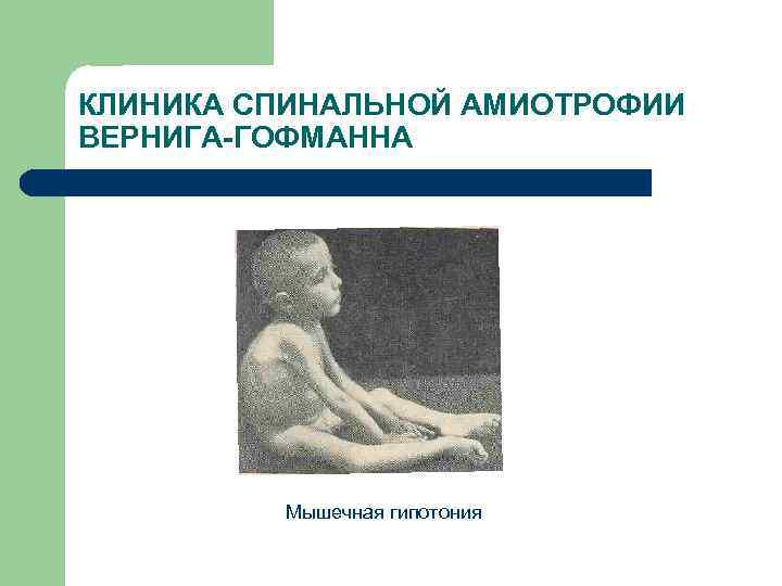 КЛИНИКА СПИНАЛЬНОЙ АМИОТРОФИИ ВЕРНИГА-ГОФМАННА Мышечная гипотония 