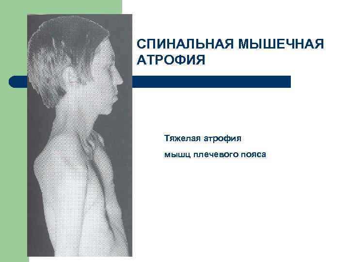 СПИНАЛЬНАЯ МЫШЕЧНАЯ АТРОФИЯ Тяжелая атрофия мышц плечевого пояса 