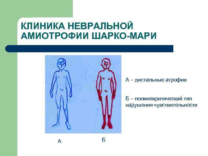 КЛИНИКА НЕВРАЛЬНОЙ АМИОТРОФИИ ШАРКО-МАРИ А – дистальные атрофии Б – полиневритический тип нарушения чувствительности