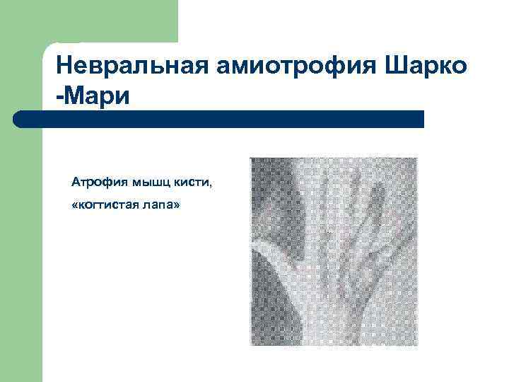 Невральная амиотрофия Шарко -Мари Атрофия мышц кисти, «когтистая лапа» 