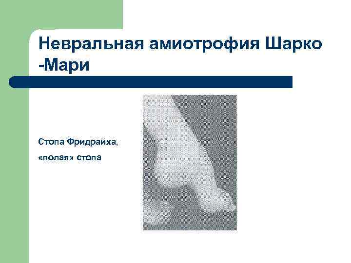 Невральная амиотрофия Шарко -Мари Стопа Фридрайха, «полая» стопа 
